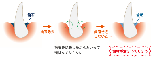 歯周病の進行過程